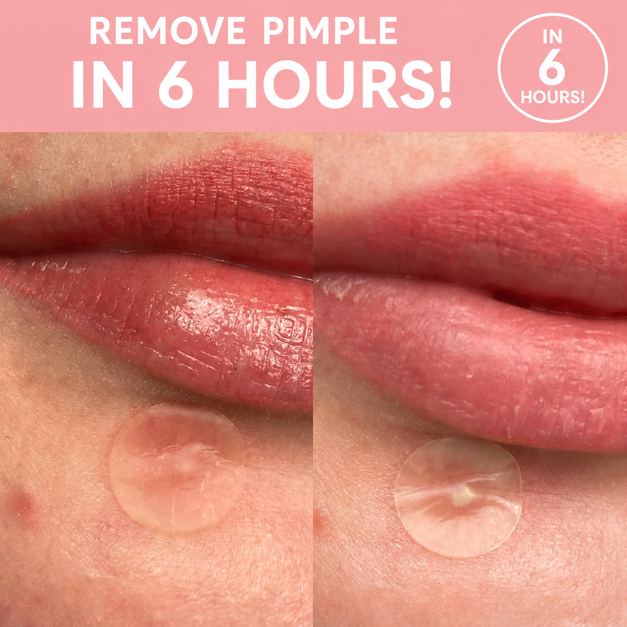 Pimple Patch™